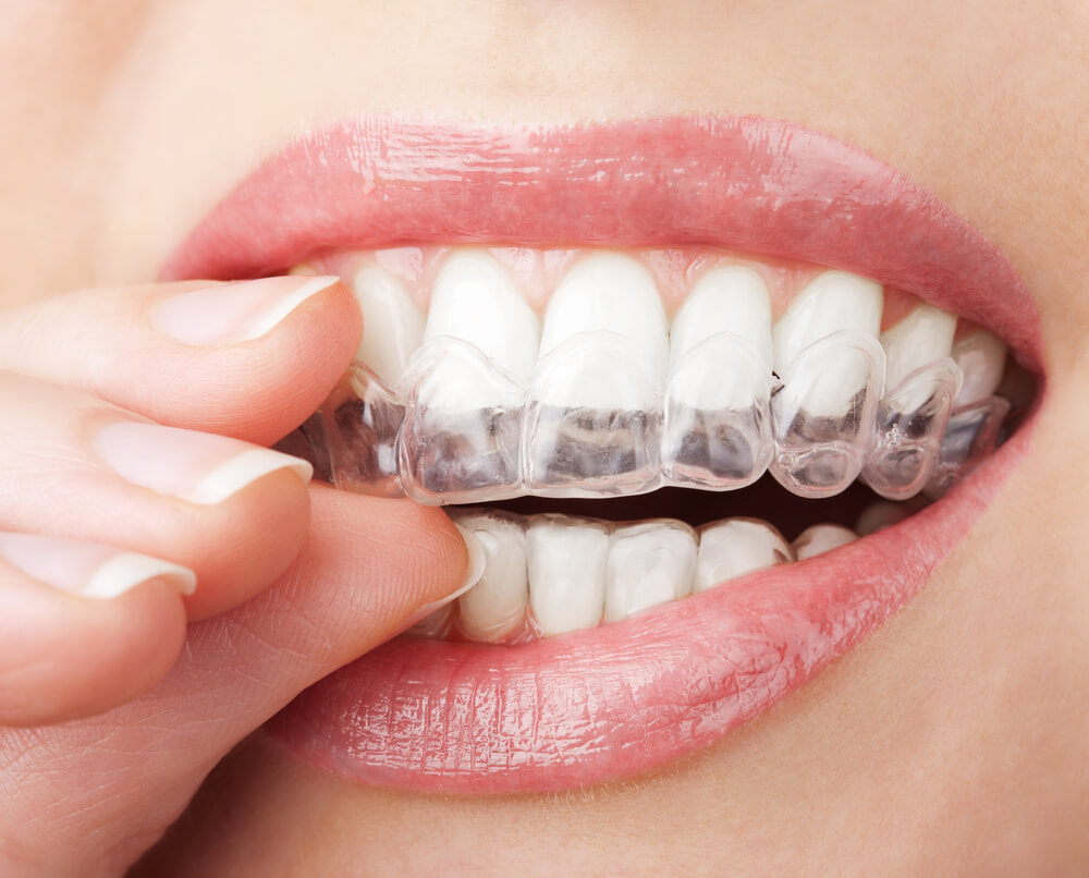 Clareamento Dental Americana